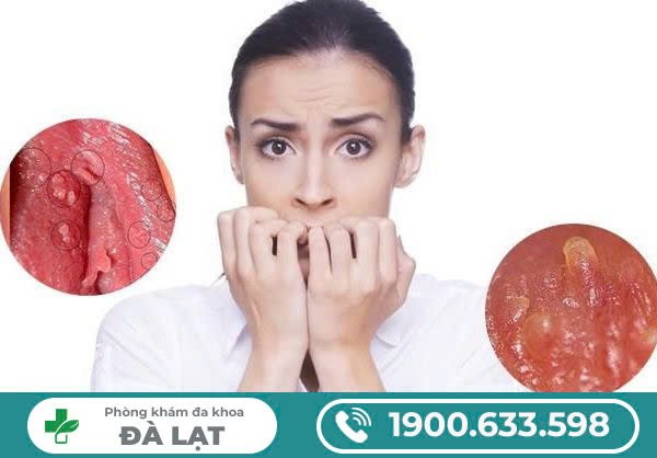 MÔI BÉ SẦN SÙI ( GAI SINH DỤC) CÓ PHẢI BỆNH XÃ HỘI KHÔNG?
